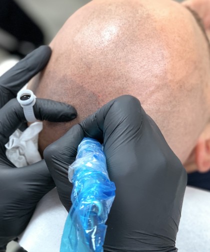 trychopigmentacja szkolenie mikropigmentacja skóry głowy