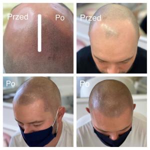 mikropigmentacja skóry głowy u mężczyzn
